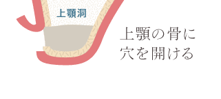 上顎の骨に穴を開ける