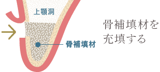 骨補填剤を充填する