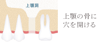上顎の骨に穴を開ける