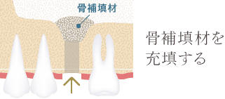 骨補填剤を充填する