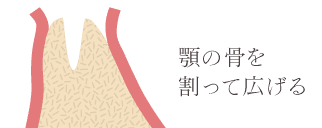 顎の骨を割って広げる