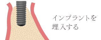 インプラントを埋入する