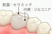 ジルコニア セラミック前装