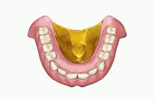 金属床義歯（チタン）