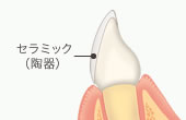 ラミネートベニア