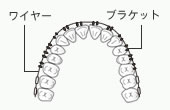 成人矯正(マルチブラケット)
