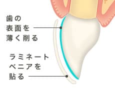 歯の表面を薄く削る　ラミネートベニアを貼る
