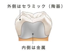 外側はセラミック（陶器）内側は金属