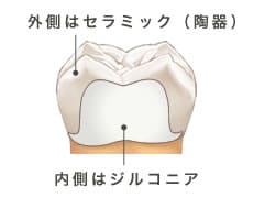 外側はセラミック（陶器）内側はジルコニア