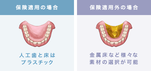 保険適用の場合 人工歯と床はプラスチック 保険適用外の場合 金属床など様々な素材の選択が可能