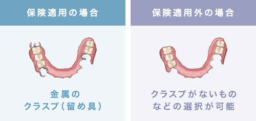 保険適用の場合 金属のクラスプ（留め具） 保険適用外の場合 クラスプがないものなどの選択が可能