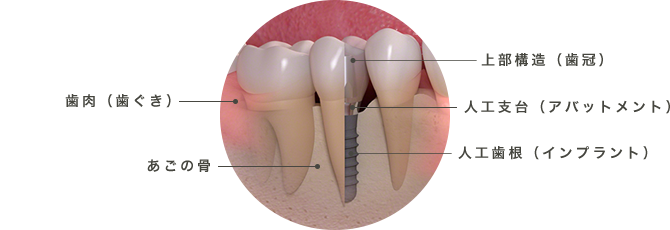 上部構造（歯冠） 人工支台（アバットメント） 人工歯根（インプラント）