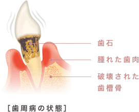 歯周病の状態