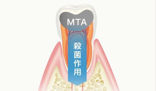 MTAセメント
