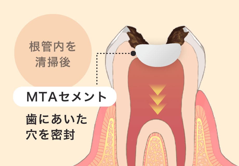 根管内を清掃後「MTAセメント」で歯にあいた穴を密封